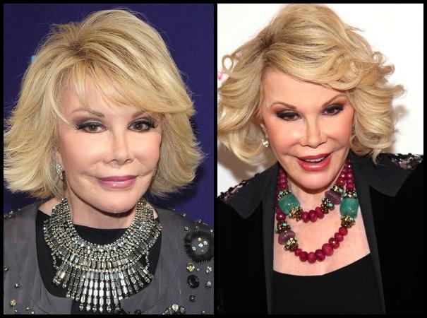 Celebrity Botox