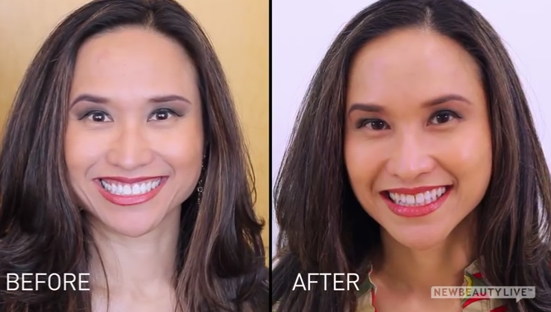 botox before after