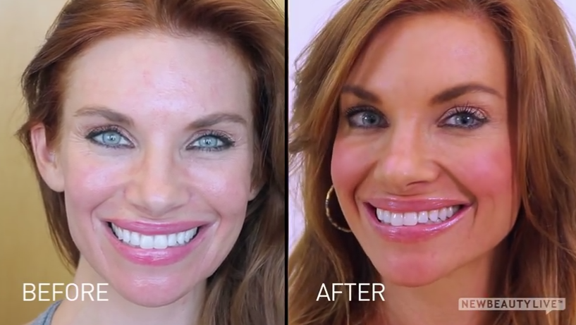 botox before after