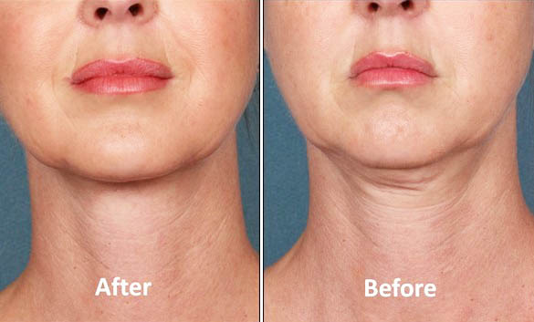 before after chin fat